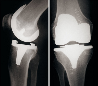 hirslanden-3d-schablone-zur-genauen-positionierung-der-knieprothese-2