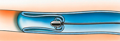 hirslanden-abbildung-krampfader