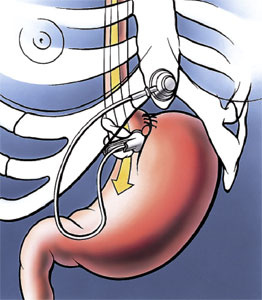 hirslanden-adipositaschirurgie-band-oder-bypass-1