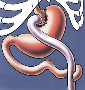 hirslanden-adipositaschirurgie-band-oder-bypass-2