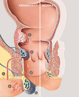 hirslanden-analer-blutabgang-1