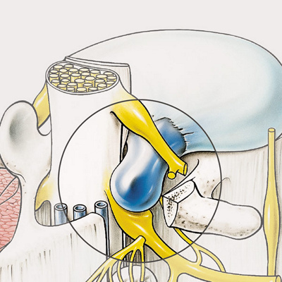 hirslanden-bandscheibenvorfall-an-der-lendenwirbelsaeule-1
