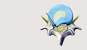 hirslanden-bandscheibenvorfall-ursachen-und-behandlung-1