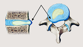 hirslanden-bandscheibenvorfall-ursachen-und-behandlung-2