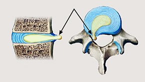 hirslanden-bandscheibenvorfall-ursachen-und-behandlung-3