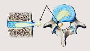 hirslanden-bandscheibenvorfall-ursachen-und-behandlung-4