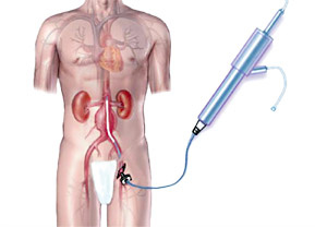 hirslanden-bauchschlagader-erweiterung-1