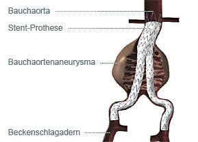 hirslanden-bauchschlagader-erweiterung-2