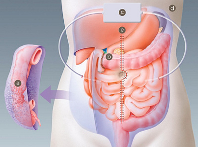 hirslanden-behandlung-von-bauch-und-brustfellmetastasen-1