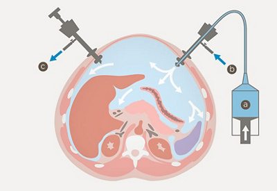 hirslanden-behandlung-von-bauch-und-brustfellmetastasen-2