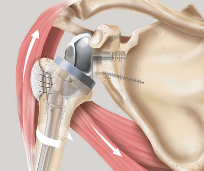 hirslanden-behandlung-von-funktionsstoerungen-der-schulter-3