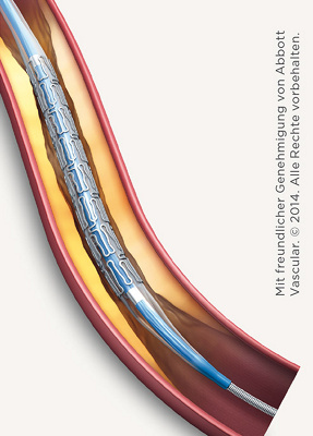 hirslanden-bei-einem-herzinfarkt-richtig-handeln-2