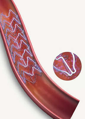 hirslanden-bei-einem-herzinfarkt-richtig-handeln-3