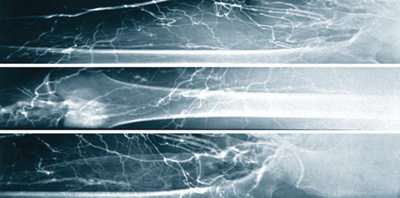 hirslanden-bein-becken-venenthrombose-2