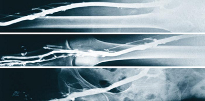 hirslanden-bein-becken-venenthrombose-3