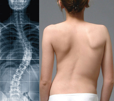 hirslanden-bewegungserhaltende-skoliose-chirurgie-1
