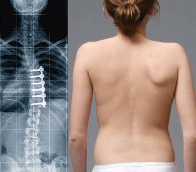 hirslanden-bewegungserhaltende-skoliose-chirurgie-2