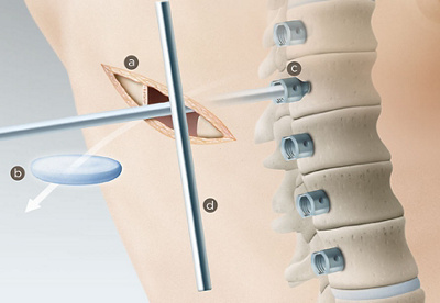 hirslanden-bewegungserhaltende-skoliose-chirurgie-3