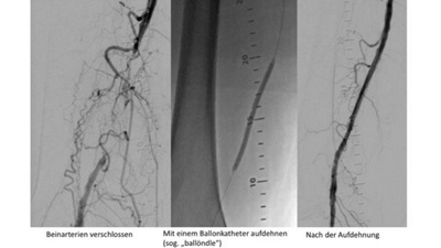 hirslanden-bild-gefaesse-beinarterie