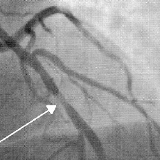 hirslanden-bioresorbierbare-stents-fuer-die-herzkranzgefaesse-1