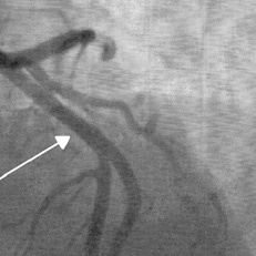 hirslanden-bioresorbierbare-stents-fuer-die-herzkranzgefaesse-2