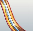 hirslanden-bioresorbierbare-stents-fuer-die-herzkranzgefaesse-3
