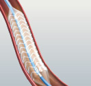 hirslanden-bioresorbierbare-stents-fuer-die-herzkranzgefaesse-4