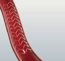 hirslanden-bioresorbierbare-stents-fuer-die-herzkranzgefaesse-5