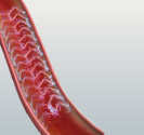 hirslanden-bioresorbierbare-stents-fuer-die-herzkranzgefaesse-6