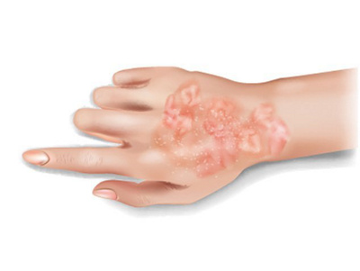 hirslanden-blogbeitrag-psoriasis-schuppenflechte