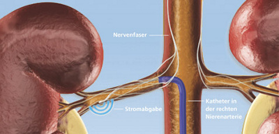 hirslanden-bluthochdruck-alte-und-neue-ideen-1