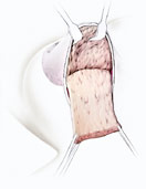 hirslanden-brustkrebs-fortschritte-bei-der-brusterhaltenden-operationstechnik-3