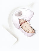 hirslanden-brustkrebs-fortschritte-bei-der-brusterhaltenden-operationstechnik-4