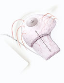 hirslanden-brustkrebs-fortschritte-bei-der-brusterhaltenden-operationstechnik-5