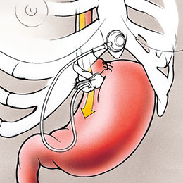 hirslanden-chirurgische-therapie-von-uebergewicht-1