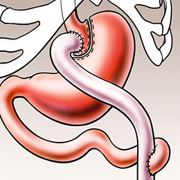 hirslanden-chirurgische-therapie-von-uebergewicht-2