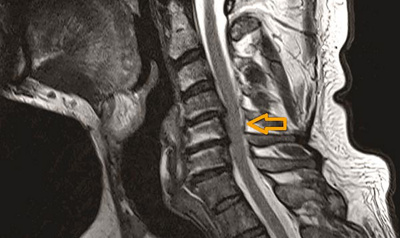 hirslanden-der-enge-spinalkanal-im-halsbereich-1