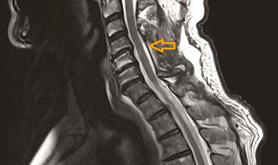 hirslanden-der-enge-spinalkanal-im-halsbereich-2