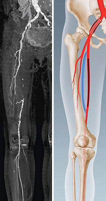 hirslanden-der-wunde-punkt-bei-durchblutungsstoerungen-1