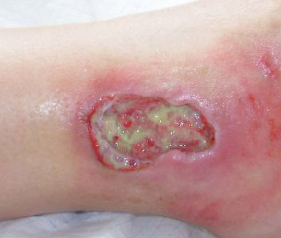 hirslanden-der-wunde-punkt-bei-durchblutungsstoerungen-2