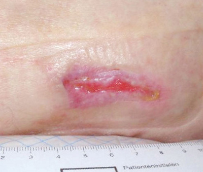 hirslanden-der-wunde-punkt-bei-durchblutungsstoerungen-3