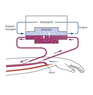 hirslanden-dialyse-2