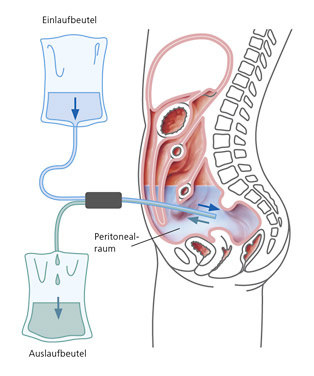 hirslanden-dialyse-3