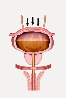 hirslanden-die-blase-nicht-mehr-kontrollieren-koennen-1