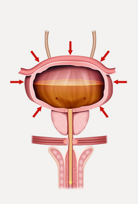 hirslanden-die-blase-nicht-mehr-kontrollieren-koennen-2