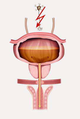 hirslanden-die-blase-nicht-mehr-kontrollieren-koennen-4