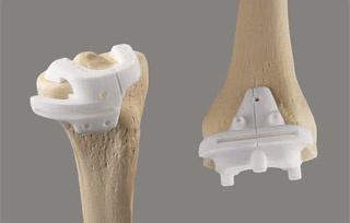 hirslanden-die-knieprothese-2