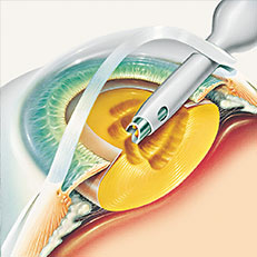hirslanden-die-operation-des-grauen-star-1