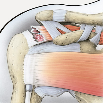 hirslanden-die-schmerzhafte-schulter-2