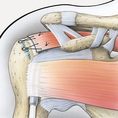 hirslanden-die-schmerzhafte-schulter-3